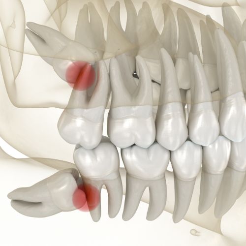 Extractions dentaires dentiste Belleville sur Meuse