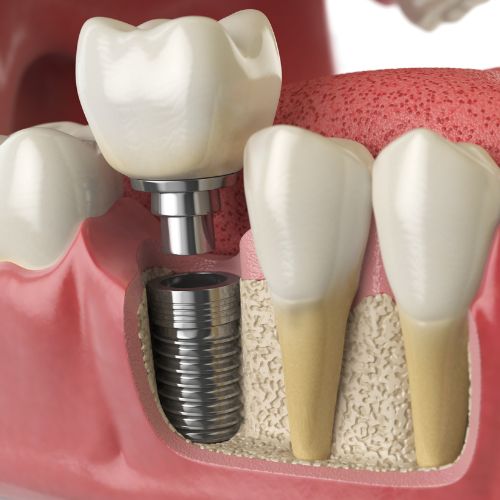 Implant dentaire dentiste belleville sur meuse