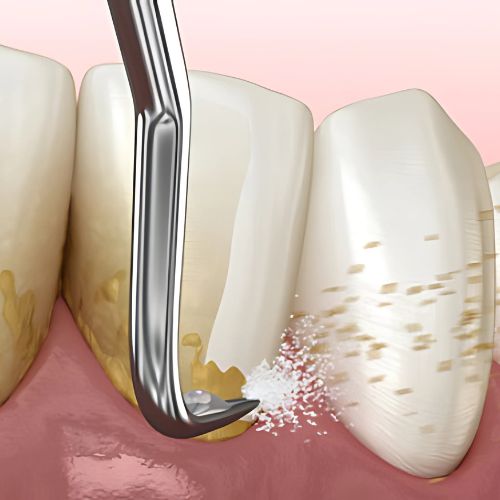 Parodontologie dentiste belleville sur meuse