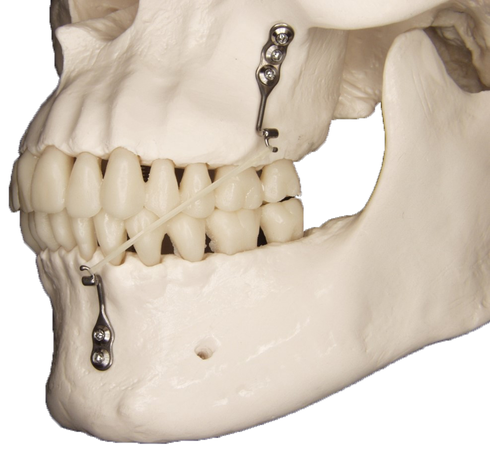 Skeletal anchorage in orthodontics